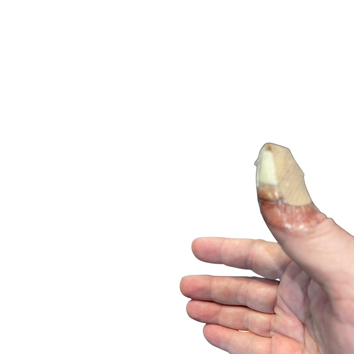 Apparently, Thumbs Are Essential: A Lesson in the Overlooked